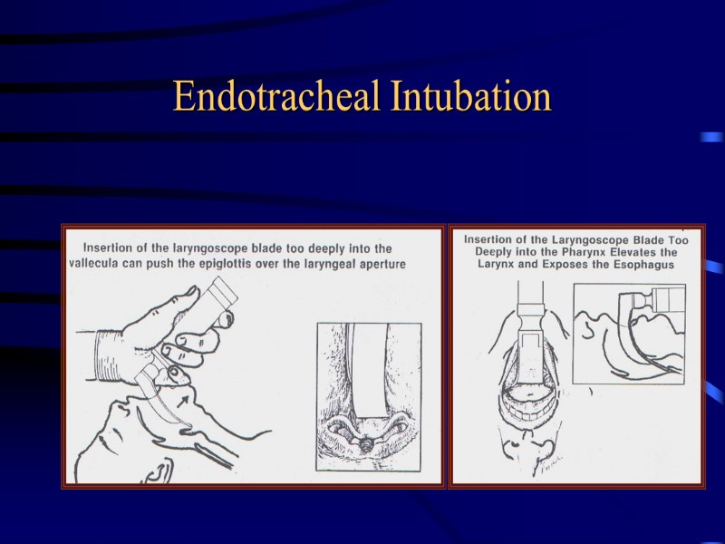 Endotracheal Intubation
